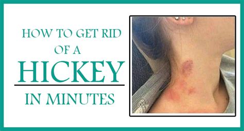 how long do hickeys last